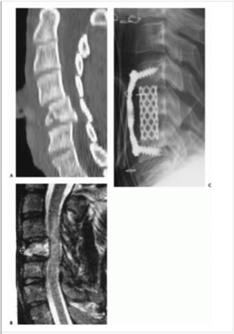 Figura 1: Radiografia lateral cervical de uma fratura explosão de C4.