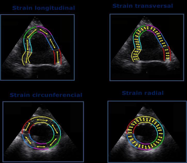 Strain: Do ponto de vista conceptual o strain pode ser definido como a deformação a que um objecto está sujeito quando submetido a uma determinada carga (stress), e exprime-se em percentagem.