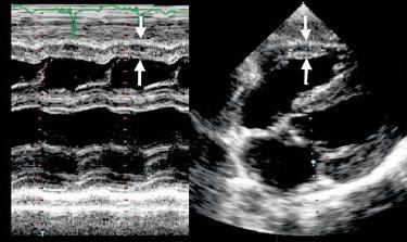 APICAL 3-CÂMARAS 2D grande profundidade. Ajustar profundidade para as 3-câmaras e posicionando o foco no VE ao nível dos músculos papilares.