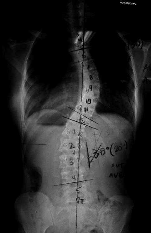 274 Pratali RR, Risso Neto MI, Veiga IG, Pasqualini W, Cavali PT, Santos MA, Rossato AJ, Lehoczki MA, Landim E A B C D Figura 1 Análise dos parâmetros estudados nas radiografias pré e