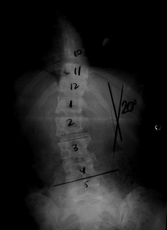 (curva menor) T12-L4 esquerda de 38º, AVT de 11 mm e AVR de 2; B) radiografia em inclinação para direita mostrando correção da curva torácica principal para 30º; C) radiografia em inclinação para