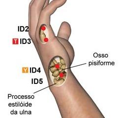 H4 [3] = ID3 Intestino Delgado (Yang) - Intestino Delgado, Olhos e Língua H4 3 (ID3) Tonificação Enxaquecas, inflamação da região inferior do abdômen, zumbidos nos ouvidos, dificuldades de audição,