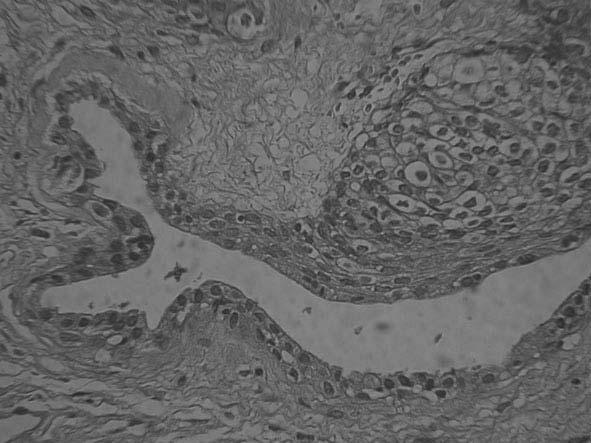 claras e áreas de hiperplasia discreta. O estroma adjacente apresentava fibrose e algumas células gigantes multinucleadas de natureza indeterminada (Figuras 2a-2c).