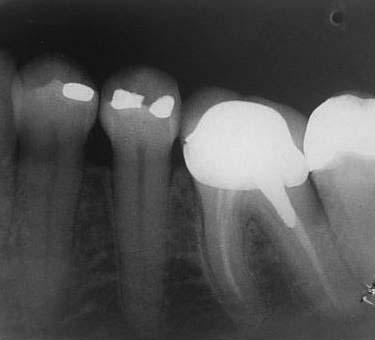 dentária de dente vita 1,4-7,10,12. Os dentes próximos à lesão cística da paciente responderam positivamente ao teste de vitalidade, confirmando o relato na literatura.