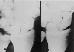 G. OHARA Fig. 7 Pseudartrose de escafóide com quatro anos de evolução e acompanhado de queixas dolorosas: A) raio X inicial; B) colocação dos fios de Kirschner através do foco de pseudartrose. Fig. 8 Evolução: A) raio X controle do sistema após três semanas de evolução; B) após oito semanas de tratamento em que se observa a consolidação.