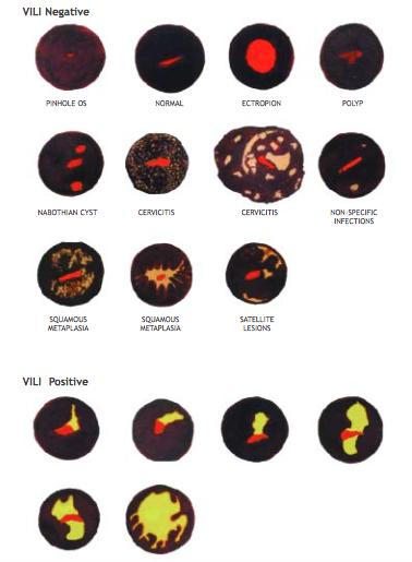 Zentralbl f Gynak 1928) VILI Visual inspection with lugol iodine VIA vs. VILI vs. citologia vs. n Taxa global de positivos 23,7% (América Latina). (Sarian LO et al. J Med Screen.