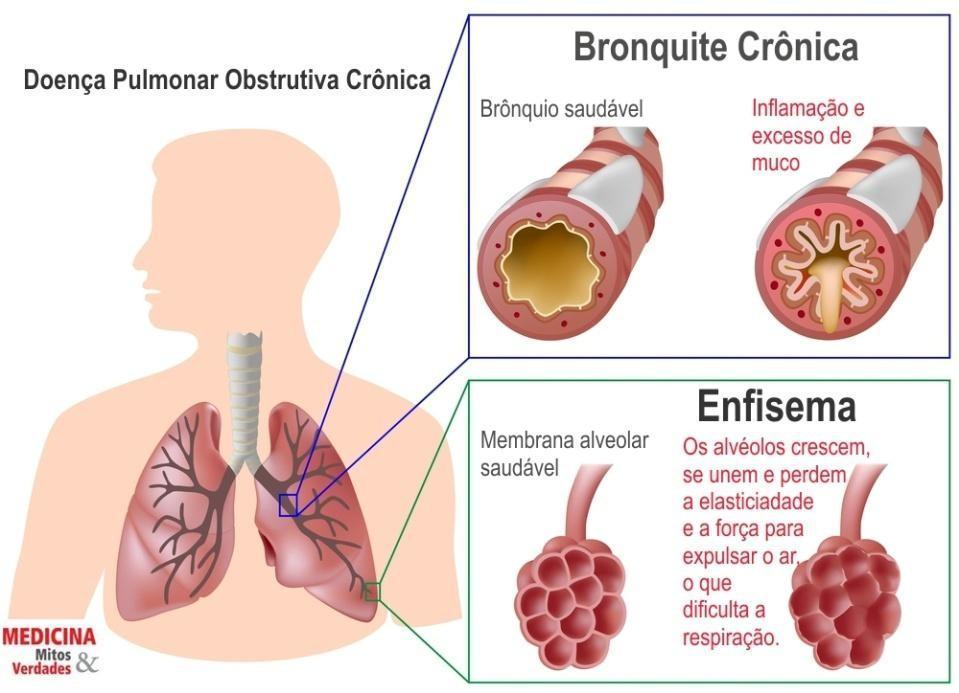 Enfisema ocorre quando os alvéolos (estruturas que transportam o oxigénio inalado para a corrente sanguínea e removem os gases da mesma através da expiração) são danificados por fumo ou outros