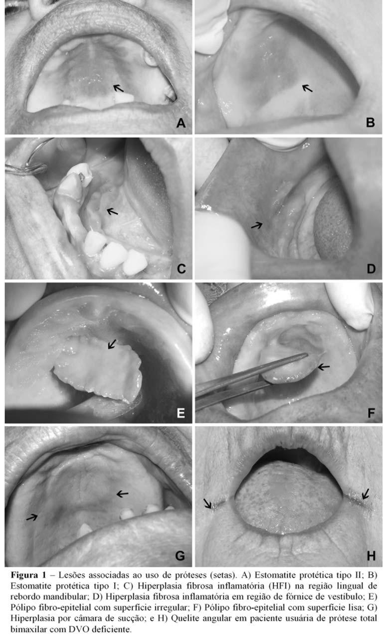 Lesões da mucosa oral em pacientes portadores de próteses dentárias: ilustrações clínicas e abordagem
