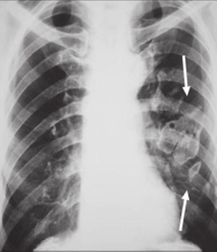 A radiografia do tórax é até hoje o método mais utilizado na avaliação das alterações pleuropulmonares relacionadas com o asbesto.