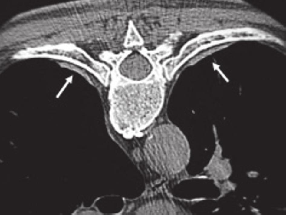 Fig. 5 Placas pleurais na parede torácica posterior na TCAR (setas). Fig. 6 TCAR demonstrando múltiplas PP parietais (setas claras) e diafragmáticas (setas escuras), algumas das quais calcificadas.