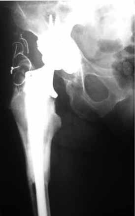 A paciente relatou fratura do colo femoral havia nove anos, quando foi submetida à artroplastia parcial do quadril e, subsequentemente, em seis anos, a duas novas