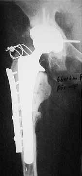 Radiograficamente, observaram-se implante estável, reabsorção da enxertia na zona II de Gruen (6), consolidação do aloenxerto na junção enxerto- -osso hospedeiro e migração do grande trocânter de 0,5