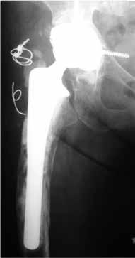 Radiograficamente, evidenciaram-se reabsorção da enxertia nas zonas I e II de Gruen (6) e sinais de instabilidade do implante femoral (sinal do pedestal) (Figura 7).