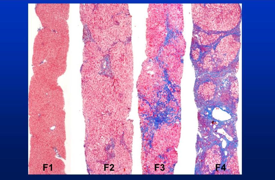 Indicação de Tratamento por Grau de Fibrose Classificação Metavir 20% terá cirrose em 20 anos de evolução Progressores rápidos, que evoluem para cirrose em menos de 20 anos; Progressores