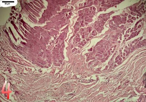O resultado da histopatologia deste 7,17 caso corrobora com os descritos anteriormente, onde é relatado atrofia, desaparecimento de fibras musculares, infiltrado de células inflamatórias, deposição