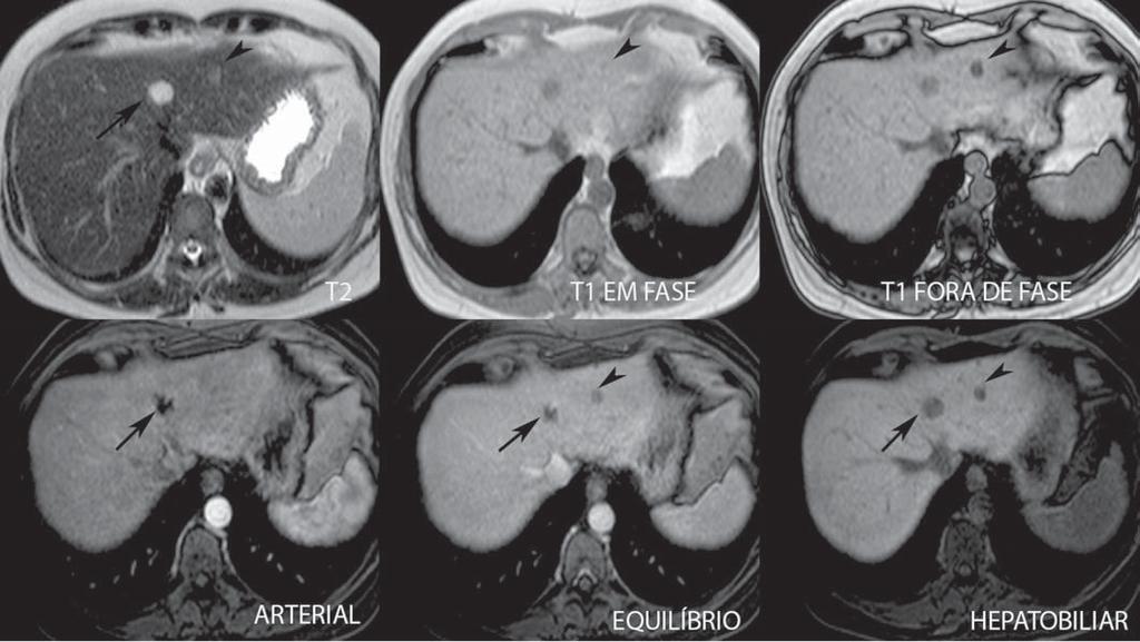 Figura 2. Paciente do sexo feminino, com 36 anos, assintomática, apresentando nódulo hepático hipervascular a esclarecer, sem gordura intralesional e sem cicatriz central.