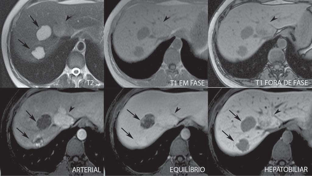 frequentemente presentes. Os hemangiomas apresentam as mesmas características de imagem no estudo dinâmico com contraste hepatobiliar.