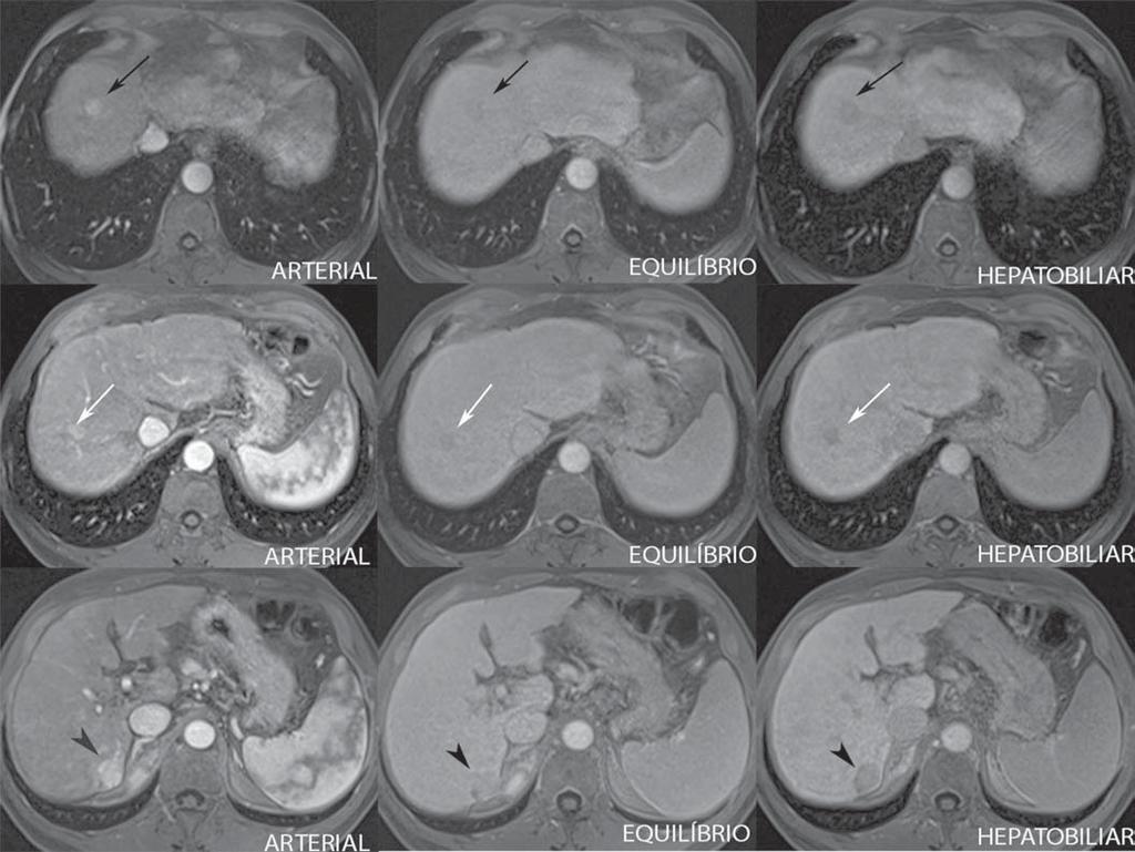 Figura 5. Paciente do sexo masculino, com 46 anos, apresentando hepatopatia crônica e nódulo hepático a esclarecer próximo à vesícula biliar, visto na ultrassonografia.