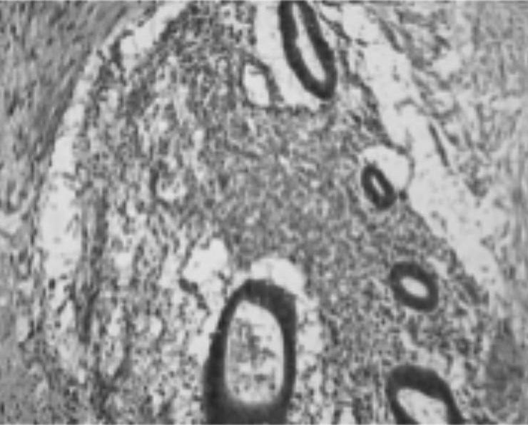 Este padrão é subclassificado, segundo a similaridade com epitélio endometrial ativo, nas seguintes formas de apresentação: - Bem diferenciada: células epiteliais tem morfologia indistinguível dos