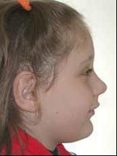 retrusão mandibular e o crecimento vertical da face. Fonte: Feres e Feres, 2013.