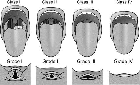 34 retrognatia ou micrognatia, geralmente, o dorso da língua está acima do plano oclusal dos dentes, o que impede que a úvula seja visualizada sem a ajuda de espátula e também dificulta a intubação