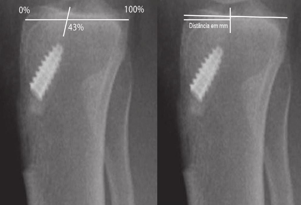 a) Medida em porcentagem do comprimento anteroposterior do platô tibial; b) medida em milímetros a partir da borda anterior do platô tibial.