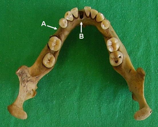 80 Resultados Figura 3 - Mandíbula. A) Alvéolo dentário com reparação óssea indicando ausência do dente antes da morte (seta).