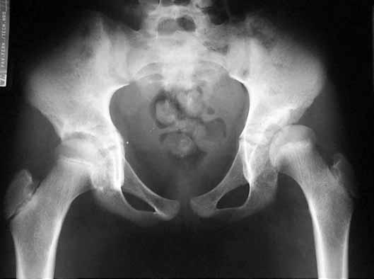 Radiografias em AP/Lauenstein da bacia definem o diagnóstico, observando-se translação e mudança na relação do colo com a cabeça femoral (Figuras 8 e 9). O tratamento é eminentemente cirúrgico.