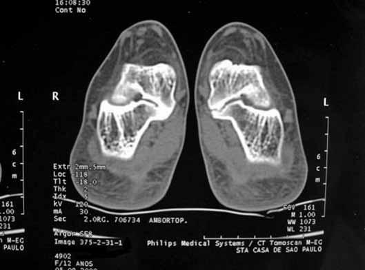 paciente e seus cuidadores e que se realize o exame físico dirigido para as afecções em questão, de forma Figura 14 Tomografia computadorizada mostrando barra óssea no pé E e barra fibrosa no pé D