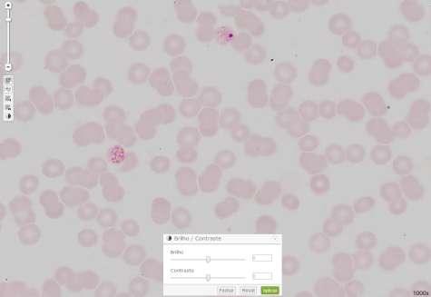 Hemoparasitologia Plasmodium malarie (1) Imagem digitalizada com aumento de 1000x, sem ajuste do brilho e contraste.