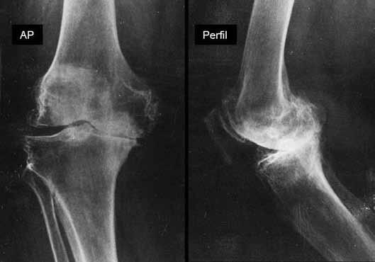 Estudo comparativo entre a classificação radiológica e análise macro e microscópica das lesões na osteoartrose do joelho 157 Lesão grave: Grau 3a extensão > 50% Grau 3b até a camada calcificada Grau