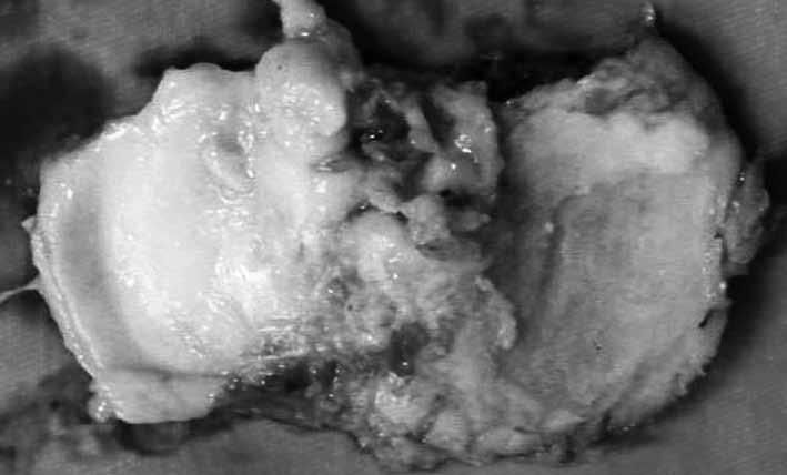 Grau Radiografia em AP com apoio monopodal Radiografia em lateral com 20º de flexão 1 2 3 4 5 Destruição moderada da cartilagem (estreitamento do espaço articular) Destruição total da cartilagem