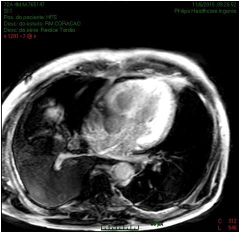 Amiloidose Cardíaca: Relato de Caso Figura 4.