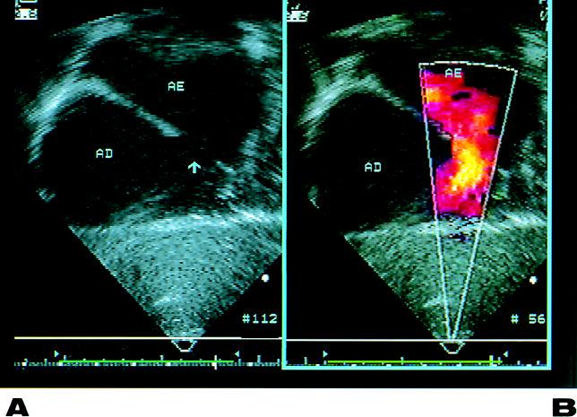 Arq Bras Cardiol Fig. 1 - Ecocardiograma bidimensional com Doppler colorido.