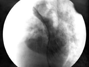 Fig. 2 - Angiografia em veia pulmonar superior direita, mostrando passagem de contraste do átrio esquerdo para o átrio direito através de amplo defeito do septo interatrial localizado em porções