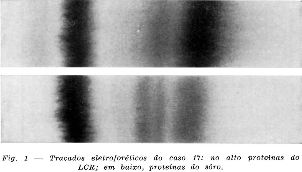 As proteínas do LCR e do soro foram analisadas mediante técnica anteriormente descrita, empregando a eletroforese em papel no seu fracionamento e foram interpretados segundo critérios de normalidade