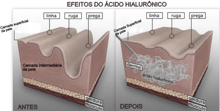 médicos especialistas nessa área. Caso a pessoa não sinta a necessidade de usá-lo como preenchimento, o AH pode ser adquirido a partir de alguns cremes dermatológicos.