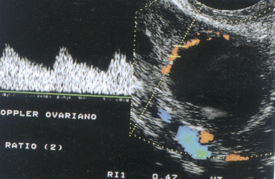 Gestação de 10 semanas.