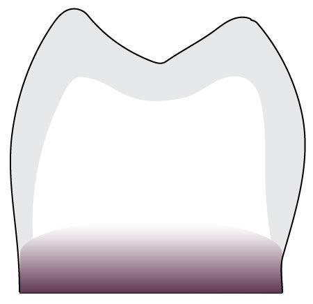 da parede oclusal Margem de coroa mínima Coroa