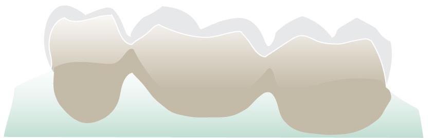 Ponte Posterior de 3 Unidades para Revestimento (máximo 1 pontico) Armação PEEK JUVORA TM Espessura mínima da parede - circunferencial Ponte posterior de 3 unidades para revestimento, máximo 1