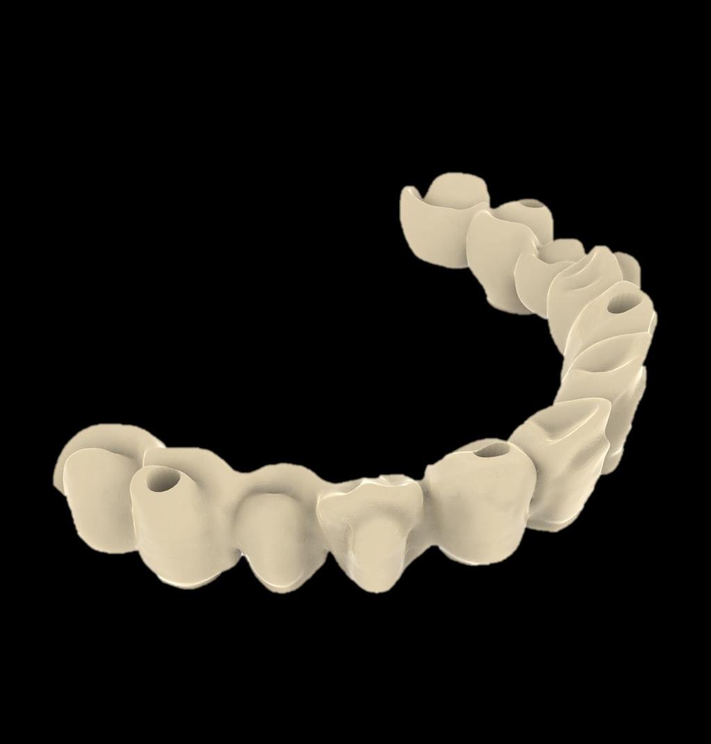Construção e Guia de Design Por Aplicação Prótese Dentária sobre Implantes Zona Palatinal do Implante: Espessura mínima para a estrutura: 1,5 mm Espessura preferível para a estrutura: 2 mm Zona