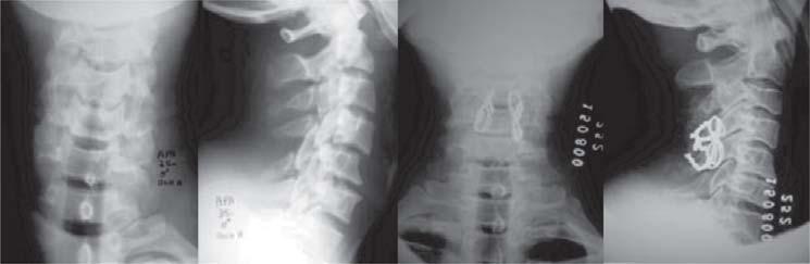 Diferentes vias de acesso cirúrgicas foram utilizadas pelos cirurgiões deste serviço. Foram realizados 22 (48,8%) procedimentos cirúrgicos através da via posterior e 16 (35,6%) por via anterior.