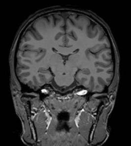 cerebral no plano coronal (d). 3.2.