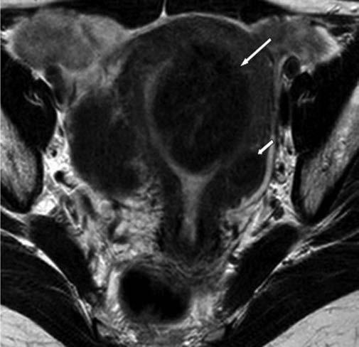 nomiomas 106. A principal pista no diagnóstico diferencial é a constatação de ovários com morfologia normal e continuidade da massa com o miométrio, caracterizando o leiomioma.