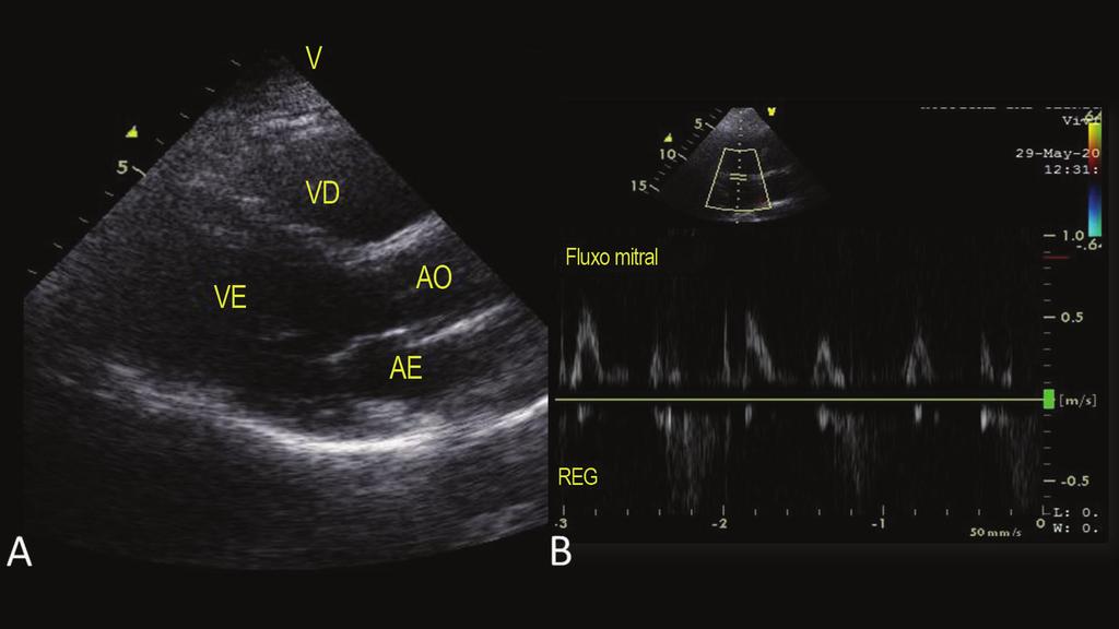 AE: átrio esquerdo; AO: aorta; VD: ventrículo direito; VE: ventrículo esquerdo.