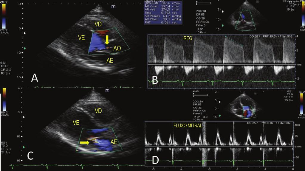 asp Figura 2 - Ecocardiograma após 2 anos do uso de medicação dopaminérgica.