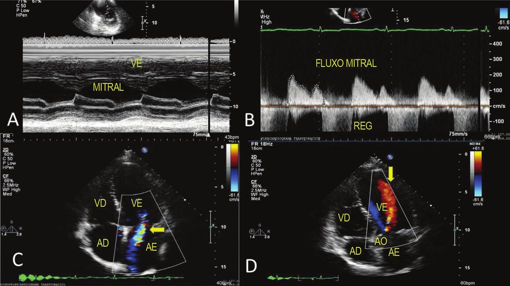 respectivamente) e refluxo mitral; C e D - Plano apical com mapeamento de fluxo em cores mostrando refluxos mitral moderado e aórtico discreto (setas amarelas) AD: átrio direito; AE: átrio esquerdo;