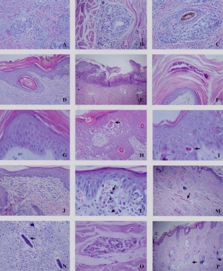 Lesões de pele em bovinos com doença granulomatosa sistêmica associada ao pastoreio de ervilhaca (Vicia spp.).