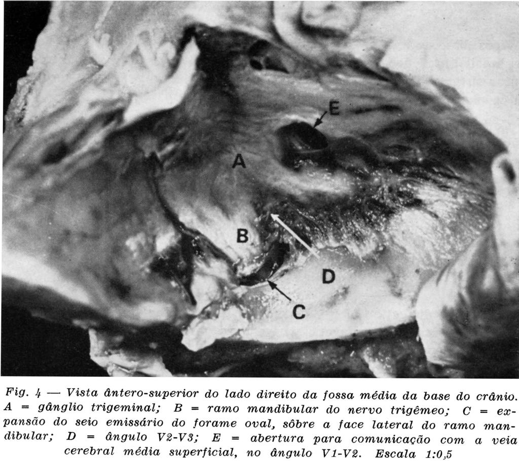 anterior da superfície medial do segmento intracraniano do nervo mandibular, inclusive sua raiz motora, em 99% dos casos examinados; e) com a face lateral do segmento intracraniano do nervo