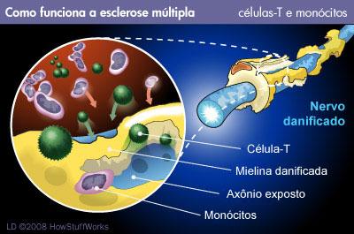 Fisiopatologia Doença autoimune: Ataca mielina ou os